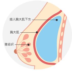隆胸手术