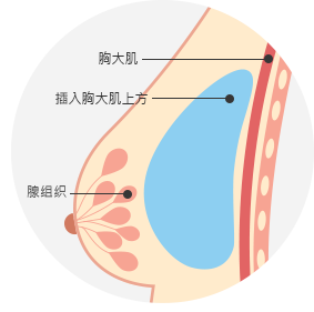 隆胸手术
