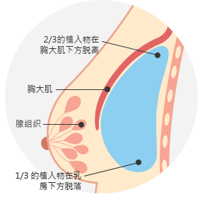 隆胸手术