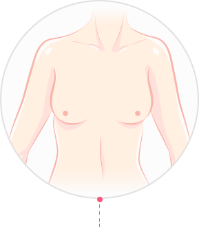 产后乳房下垂整形