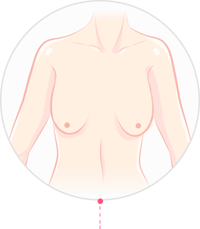 产后乳房下垂整形