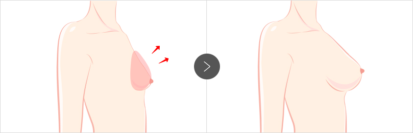 产后乳房下垂整形