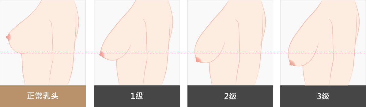 下垂乳房矫正