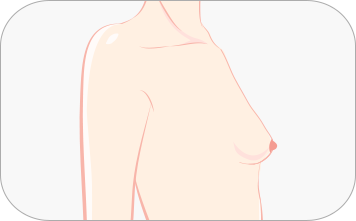 下垂乳房矫正