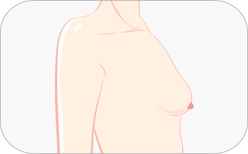 下垂乳房矫正