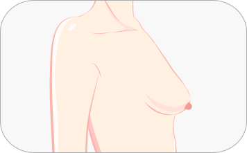 下垂乳房矫正