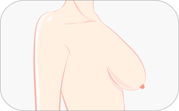 下垂乳房矫正