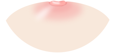 乳头·乳晕成形术