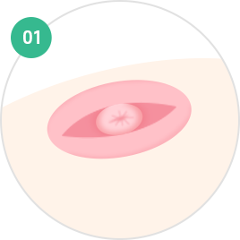 乳头·乳晕成形术