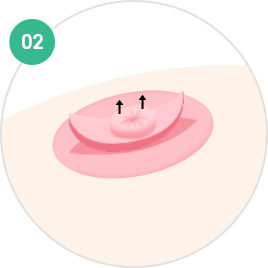 乳头·乳晕成形术