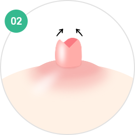 乳头·乳晕成形术
