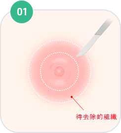 乳头·乳晕成形术