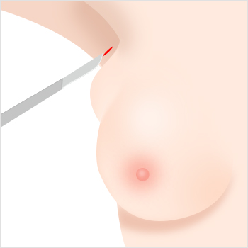 副乳·副乳头切除术