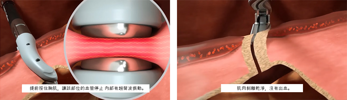 MD无血胸部整形