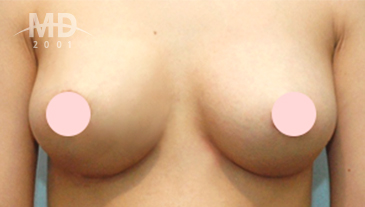 乳房二次手术