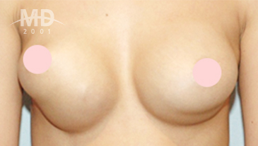 乳房二次手术