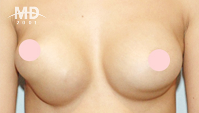 乳房二次手术
