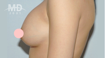 乳房二次手术
