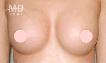 乳房二次手术