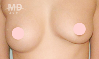 乳房二次手术