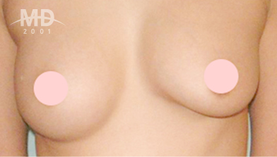 乳房二次手术