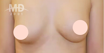乳房二次手术