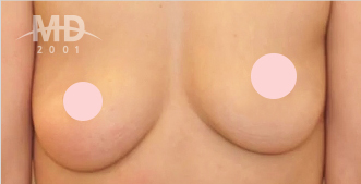 乳房二次手术