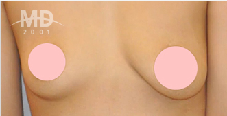 乳房二次手术