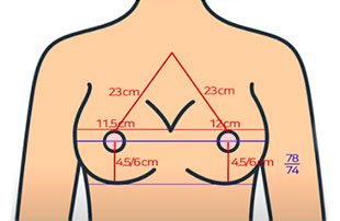 乳房二次手术