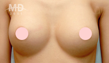乳房二次手术