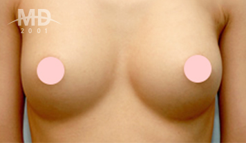 乳房二次手术