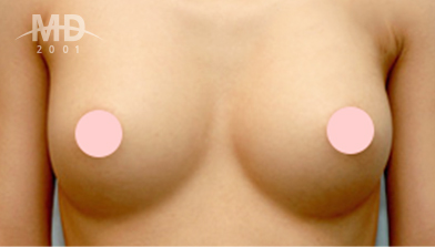 乳房二次手术