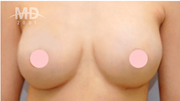乳房二次手术