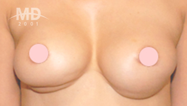 乳房二次手术