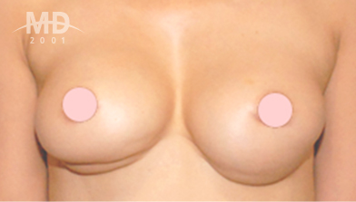 乳房二次手术