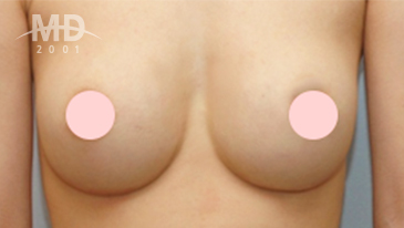 乳房二次手术