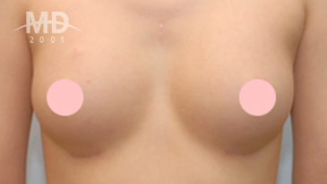 乳房二次手术