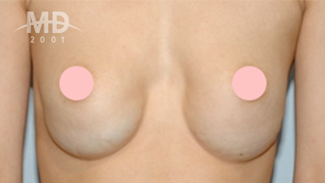乳房二次手术