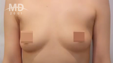乳房二次手术