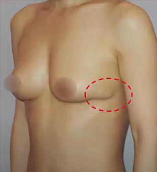 乳房二次手术