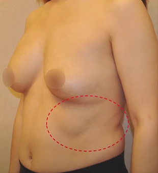 乳房二次手术
