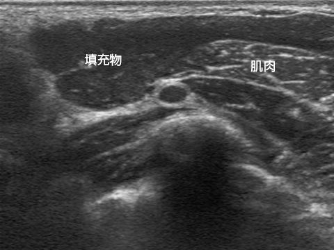乳房二次手术