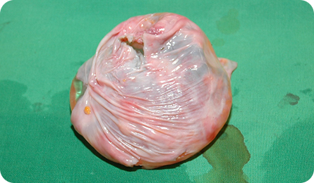 乳房二次手术