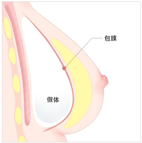 乳房二次手术