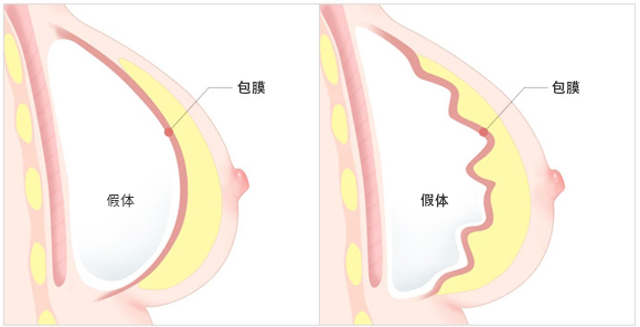 乳房二次手术