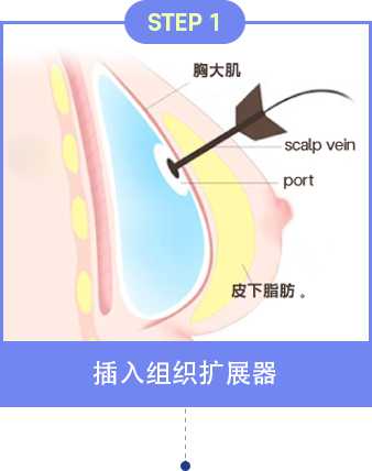 乳房重建术