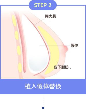 乳房重建术