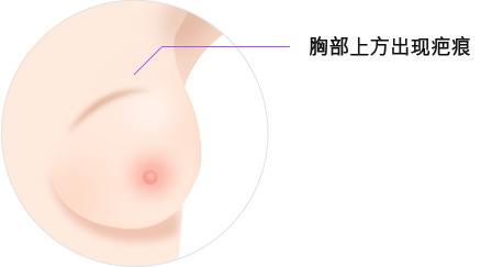 乳房重建术
