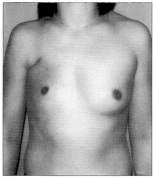 波兰综合征乳房矫正
