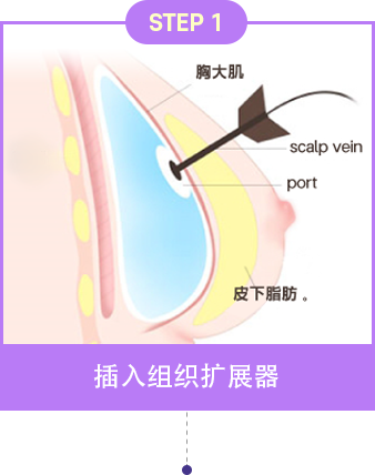 波兰综合征乳房矫正